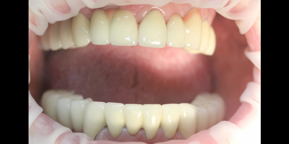  Комплексное восстановление жевательной и эстетической функции зубов