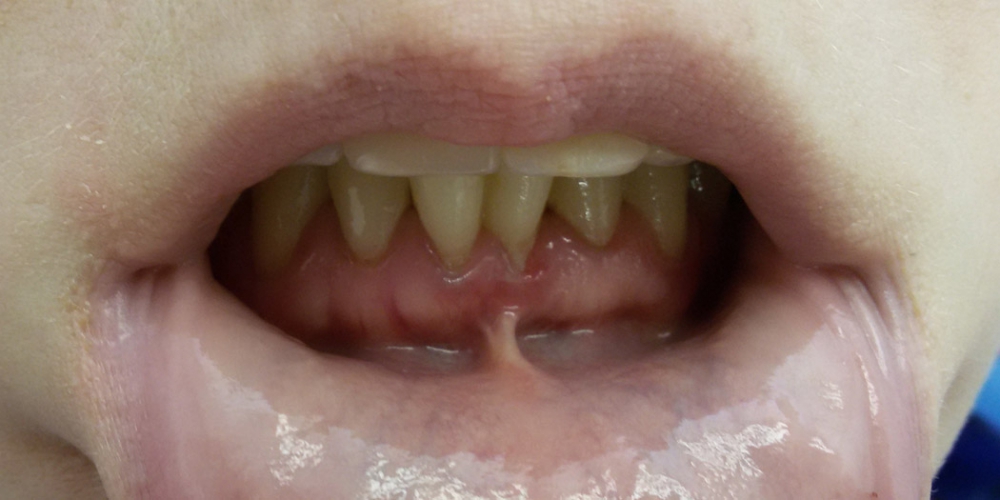  Результат лечения оголения корней передних зубов