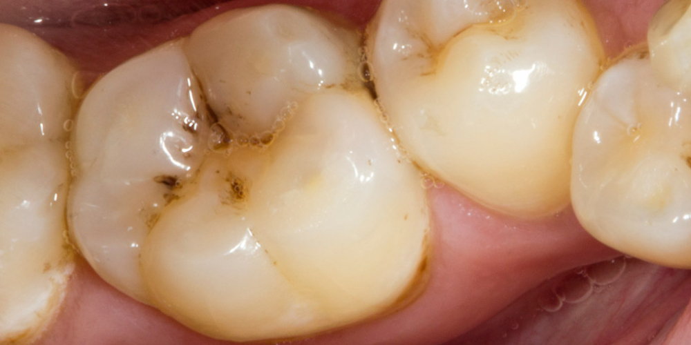  Результат реставрации жевательного зуба Filtek Ultimate