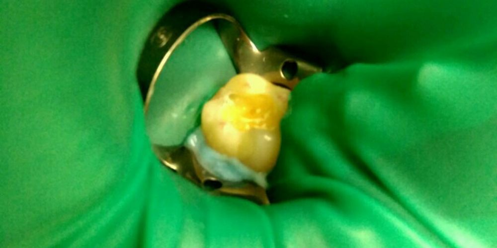  Лечение кариеса на жевательном зубе материалом FiltekZ550