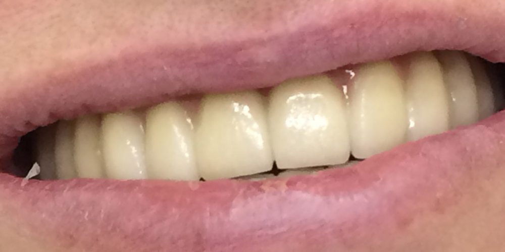  Дентальная имплантация зубов верхней челюсти