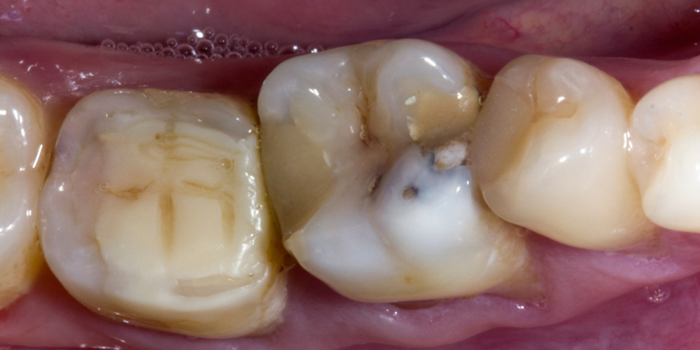  Обострение хронического фиброзного пульпита зуба 3.6