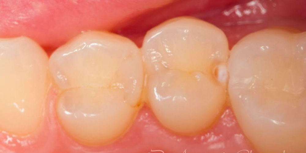  Лечение кариеса трех зубов подряд