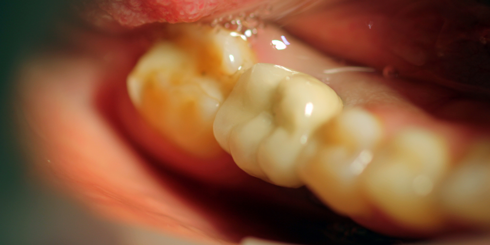  Восстановление отсутствующего зуба с помощью имплантата Ankylos и металлокерамической коронкой