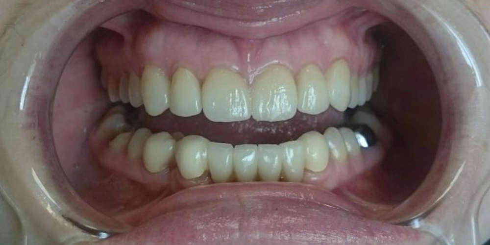  Полная реконструкции фронтальной группы зубов верхней и нижней челюсти безметалловыми конструкциями