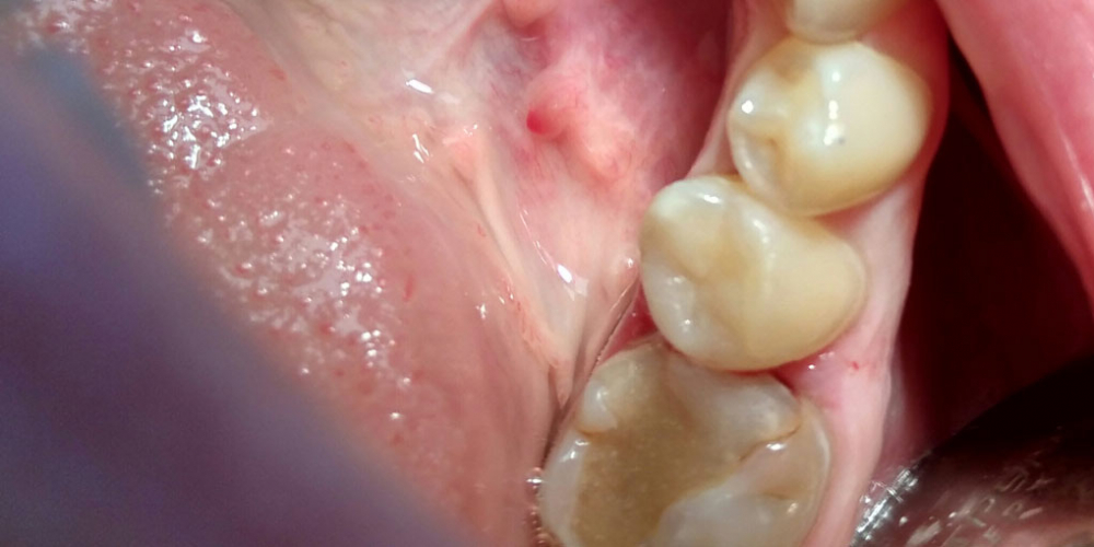  Лечение кариеса депульпрованного  зуба 45 с реставрацией анатомической формы материалом FiltekZ550