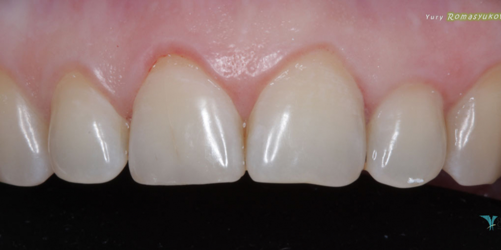  Востановление скола зуба, центрального резца