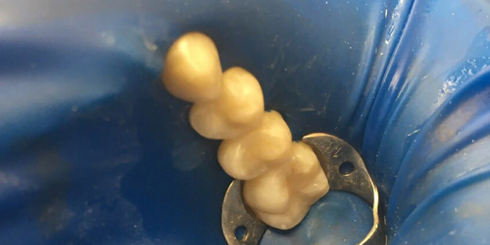  Лечение кариеса двух жевательных зубов