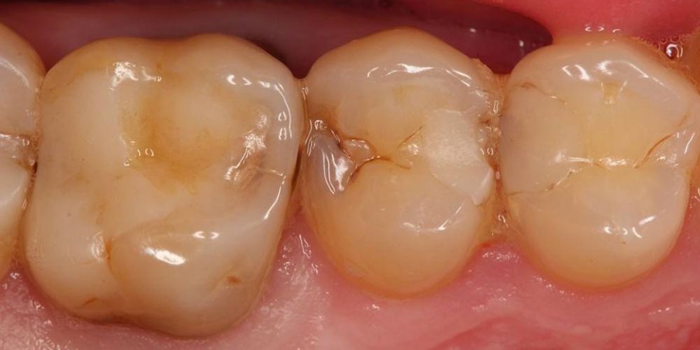  Реставрация зуба 25, лечение от чувствительных и термических раздражений, застревание пищи