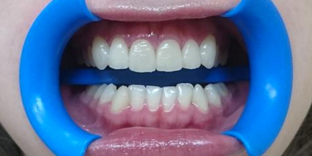  Эстетическая реабилитация фронтальных зубов с пластикой десневого края