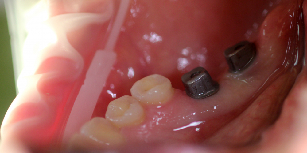  Восстановление зубного ряда с помощью имплантатов Ankylos и металлокерамических коронок
