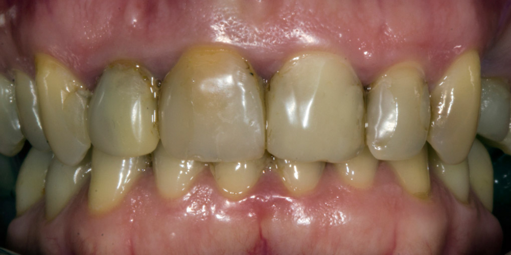  Результат прямой композитной реставрации зубов материалом Filtek Ultimate
