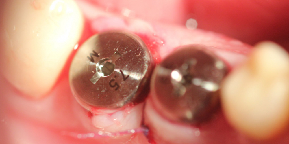  Удаление двух зубов и вживление имплантатов одномоментно