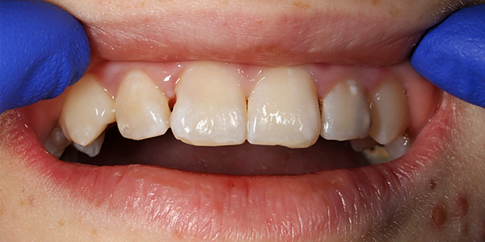  Лечение кариеса и реставрация передних зубов пломбировочным материалом