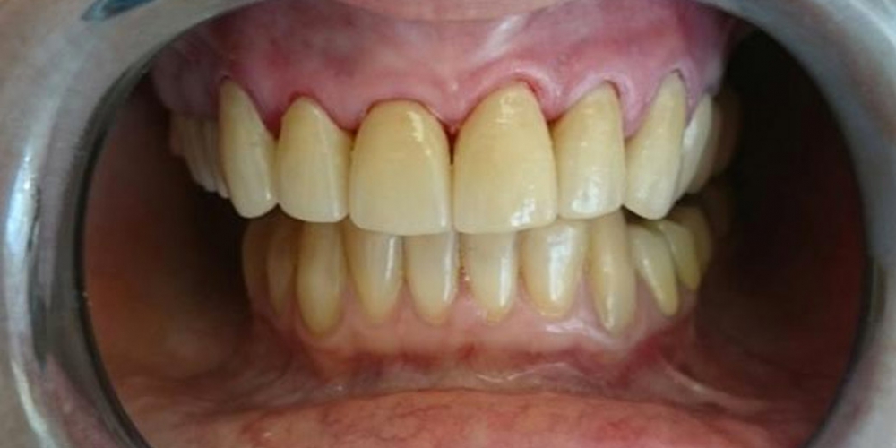  Эстетическая реабилитация фронтальной группы зубов винирами IPS e.max