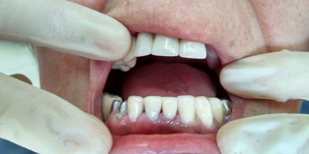  Реставрация зубов трех зубов материалом FiltekZ550