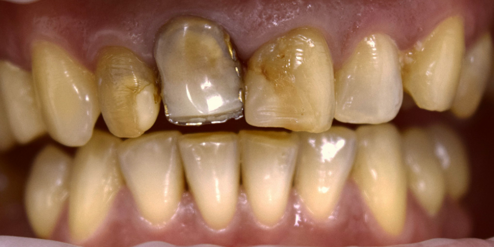  Лечение десен и эстетическая реставрация передних зубов