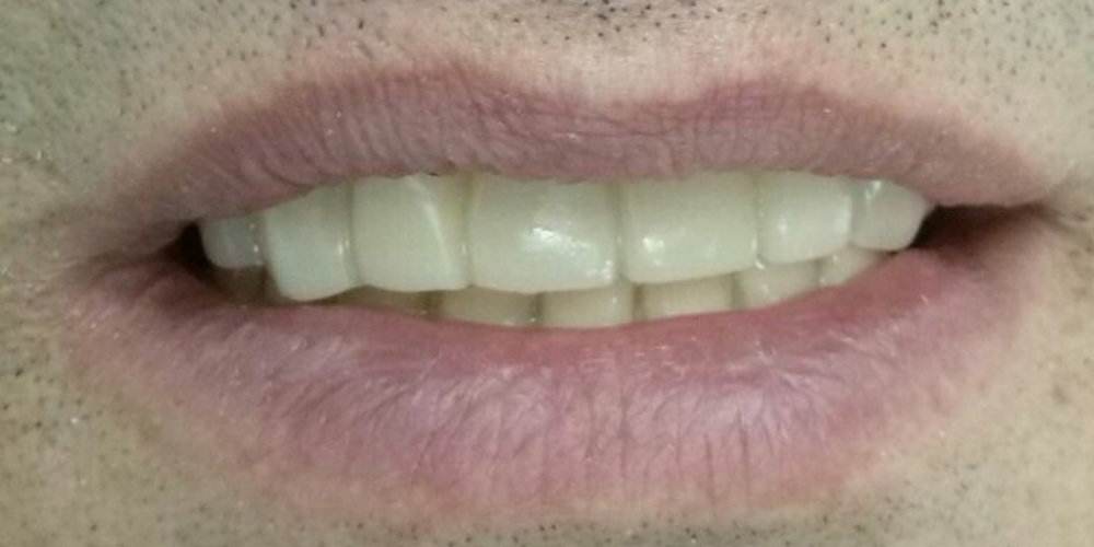  Имплантация зубов системой Osstem на верхнюю челюсть + протезирование