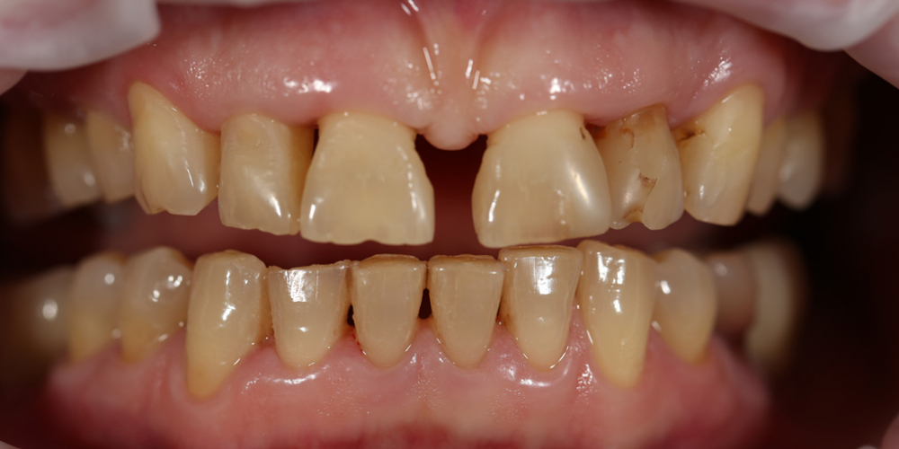  Устранение щели между передними зубами с помощью виниров E-MAX