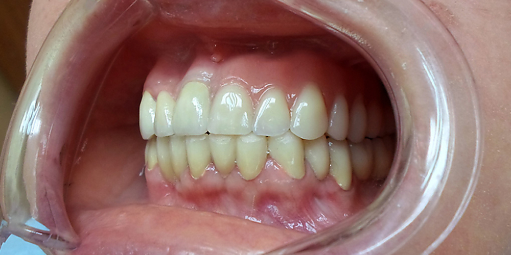  Протезирование зубов верхней челюсти при потере большого количества зубов
