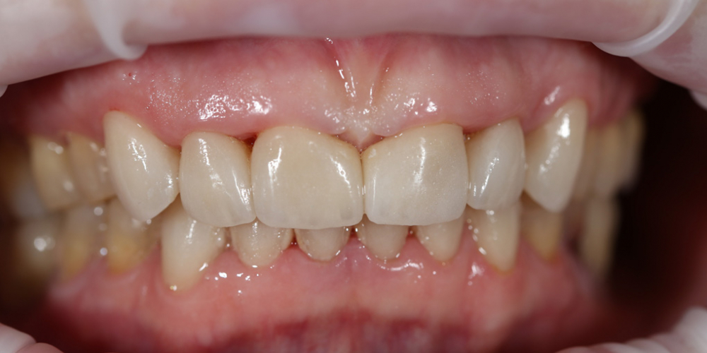  Устранение щели между передними зубами с помощью виниров E-MAX