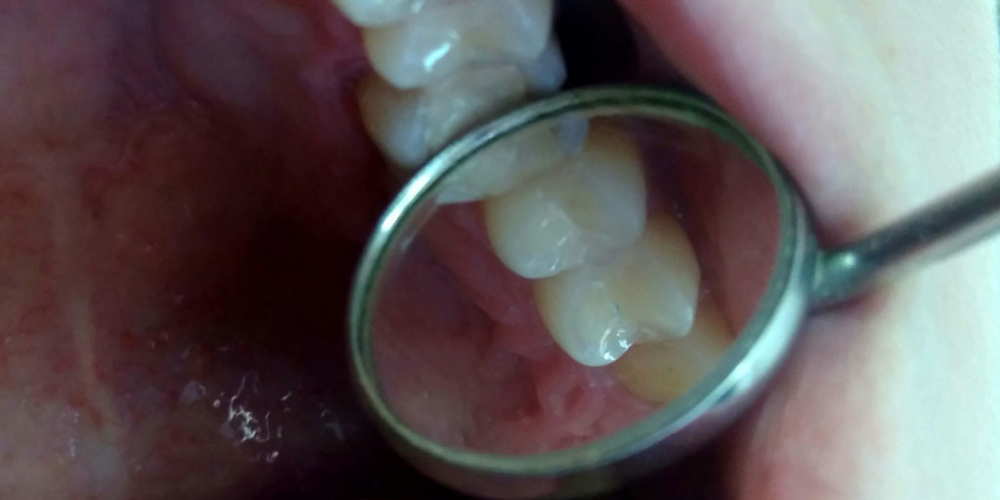  Лечение глубокого кариеса зубов 24,25, реставрация материалом FiltekZ550