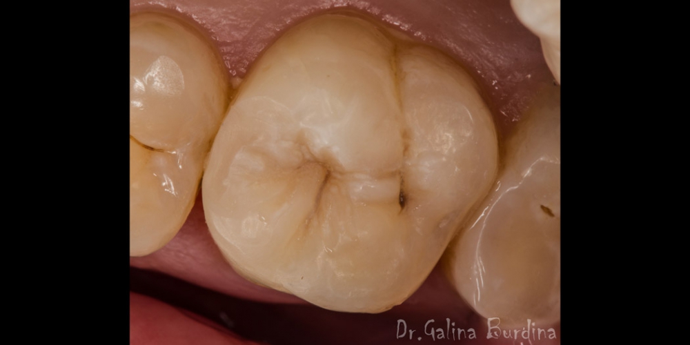  Эстетическая реставрация жевательного зуба 2.6