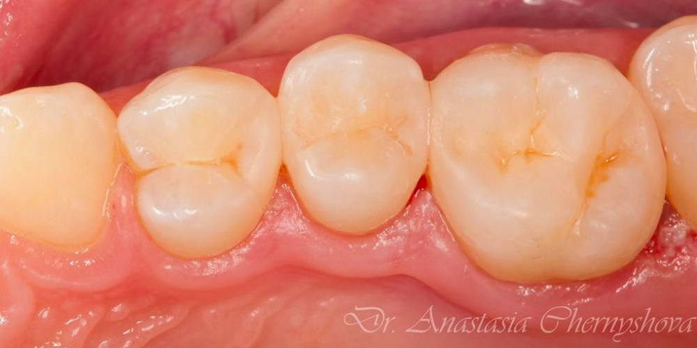  Лечение кариеса трех зубов подряд