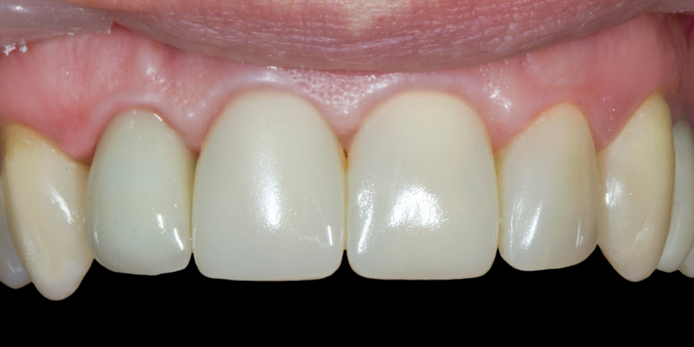  Результат прямой композитной реставрации зубов материалом Filtek Ultimate