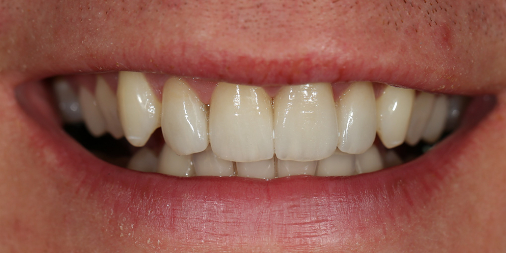  Сделать цвет зубов равномерным и естественным, убрать сколы и выровнять несимметричные края зубов