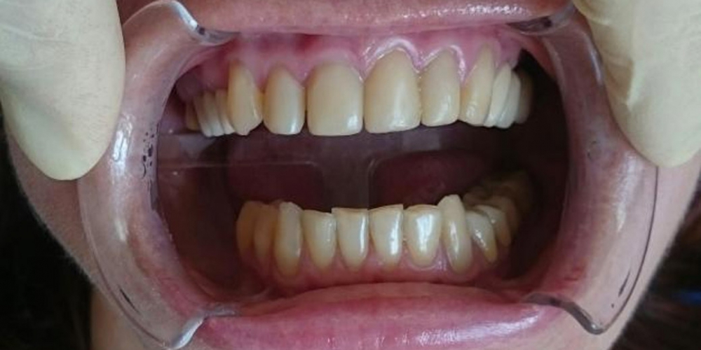  Эстетическая реабилитация фронтальной группы зубов винирами IPS e.max