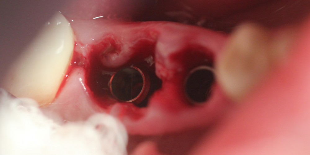  Удаление двух зубов и вживление имплантатов одномоментно