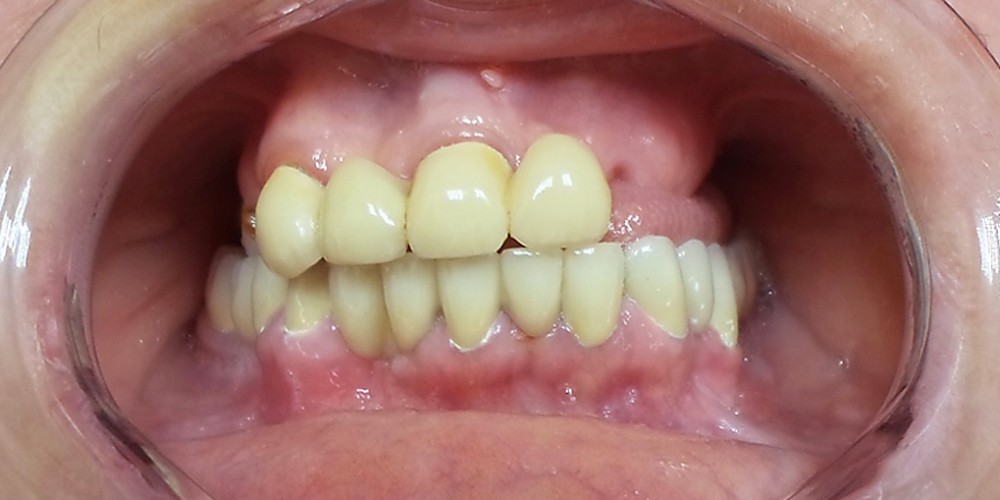  Протезирование зубов верхней челюсти при потере большого количества зубов