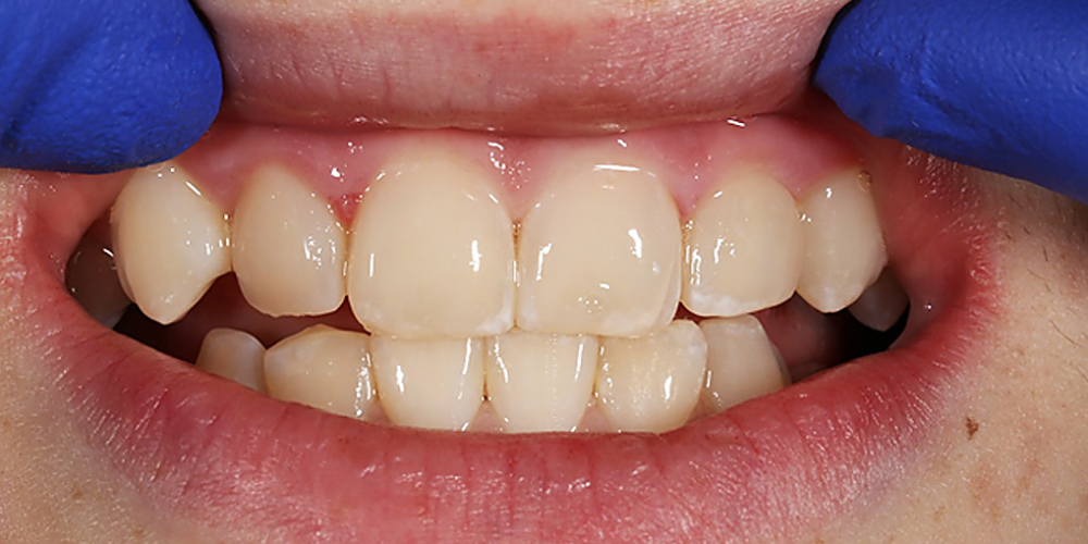  Лечение кариеса и реставрация передних зубов пломбировочным материалом