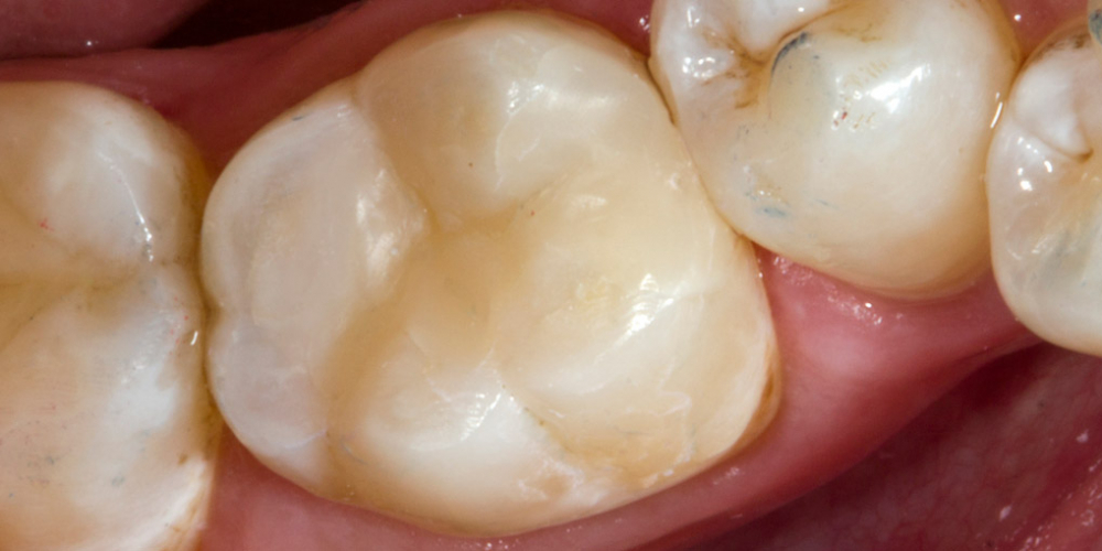  Результат реставрации жевательного зуба Filtek Ultimate