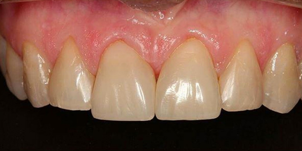  Закрытие диастемы (убрать промежуток между зубами)