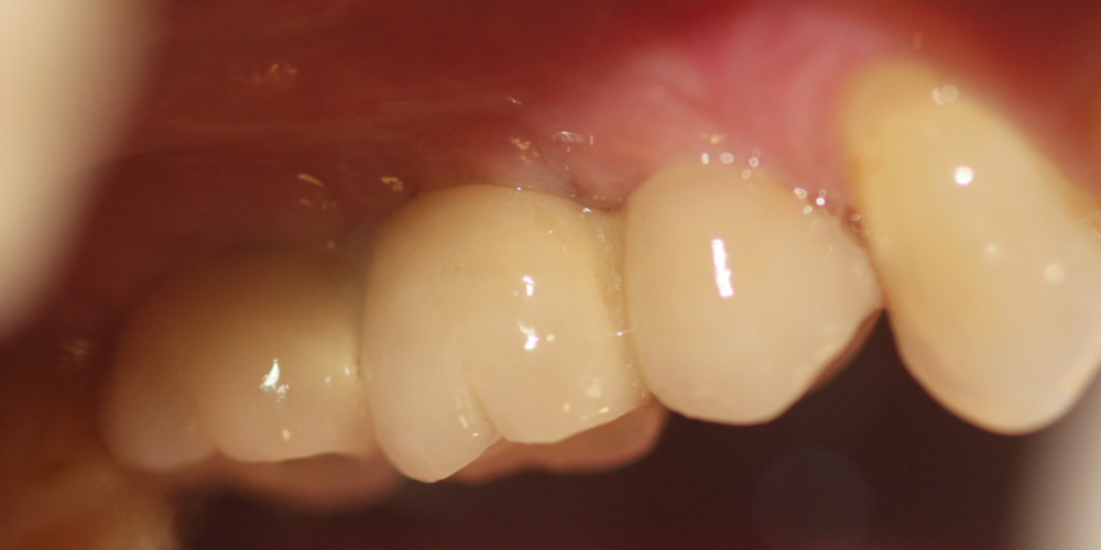  Восстановление двух зубов подряд: имплантация, синус-лифтинг, протезирование
