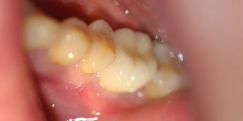  Удаление зуба с одномоментной установкой имплантата DENTIUM + протезирование
