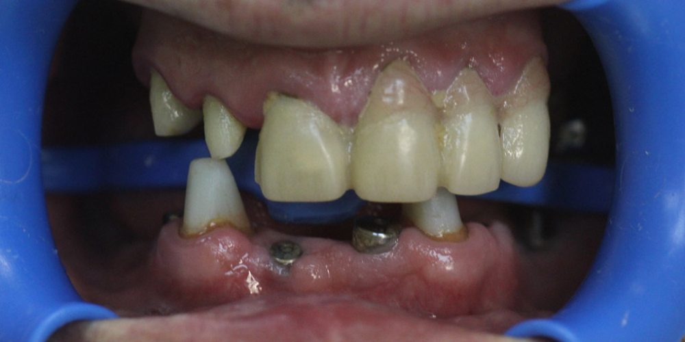  Полная эстетико-функциональная реабилитация зубов