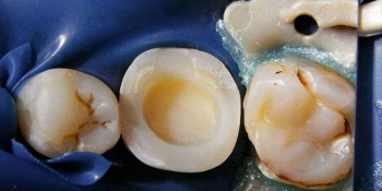 Композитная вкладка overlay 46 зуба фото до лечения