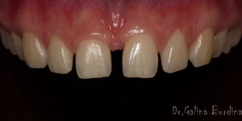 Художественная реставрация передних 6 зубов фото до лечения