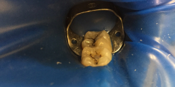 Лечение кариеса на чувствительных зубах фото до лечения