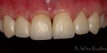 Художественная реставрация передних 6 зубов фото после лечения