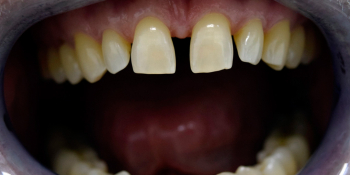 Закрытие диастемы зубов керамическими винирами фото до лечения
