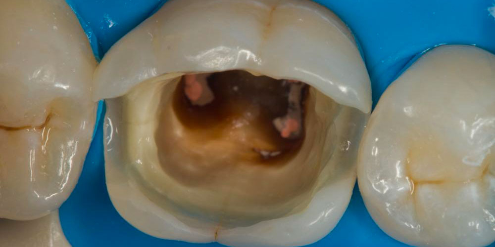  Восстановление зуба после эндодонтического лечения