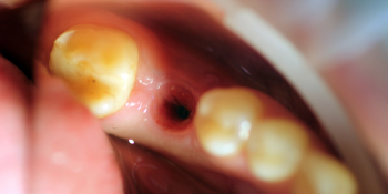 Восстановление отсутствующего зуба с помощью имплантата Ankylos и металлокерамической коронкой фото до лечения