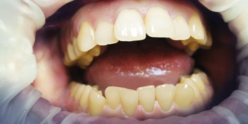 Лазерное отбеливание зубов фото до лечения