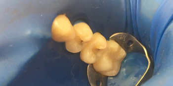 Лечение кариеса двух жевательных зубов фото до лечения