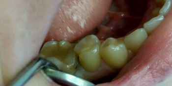 Лечение кариеса депульпрованного  зуба 45 с реставрацией анатомической формы материалом FiltekZ550 фото до лечения