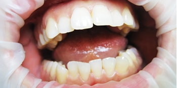 Лазерное отбеливание зубов фото после лечения